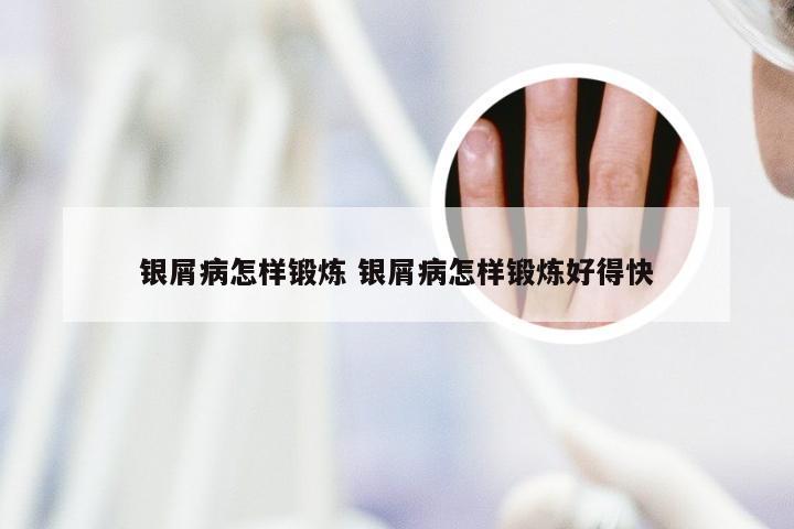 银屑病怎样锻炼 银屑病怎样锻炼好得快