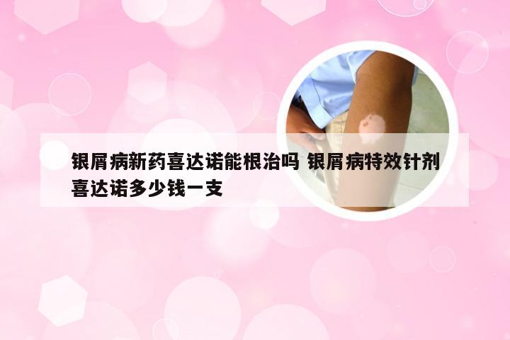 银屑病新药喜达诺能根治吗 银屑病特效针剂喜达诺多少钱一支