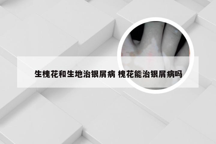 生槐花和生地治银屑病 槐花能治银屑病吗