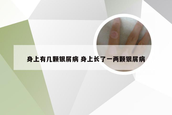 身上有几颗银屑病 身上长了一两颗银屑病