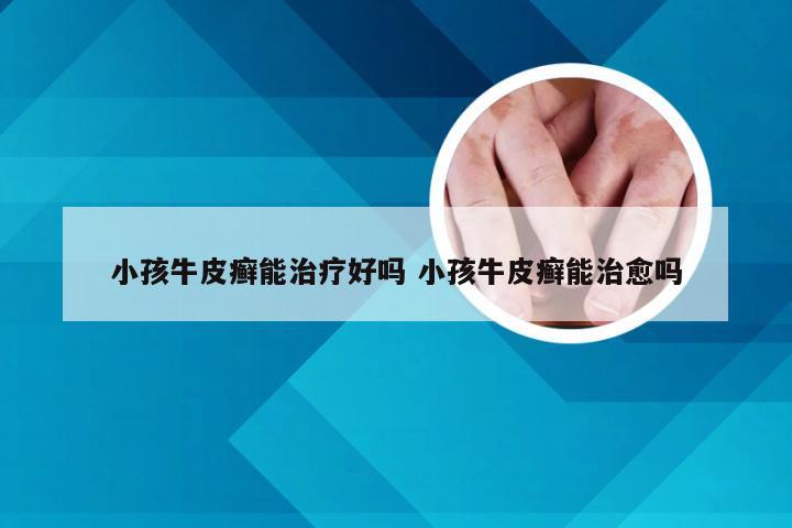 小孩牛皮癣能治疗好吗 小孩牛皮癣能治愈吗
