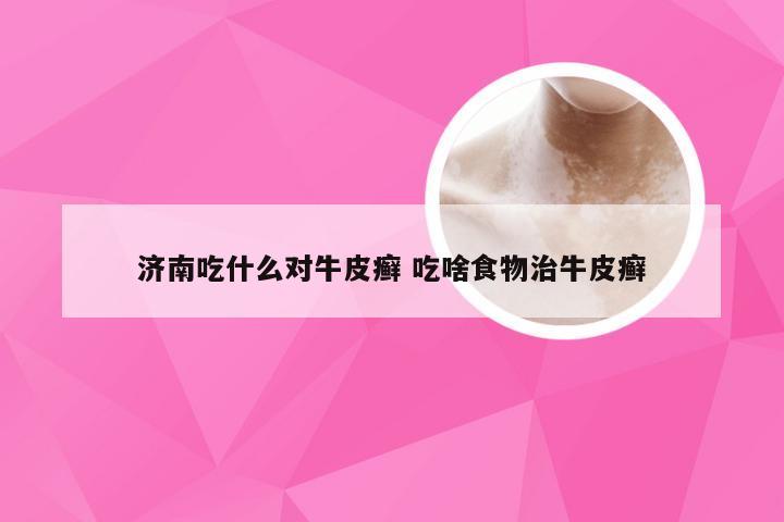 济南吃什么对牛皮癣 吃啥食物治牛皮癣