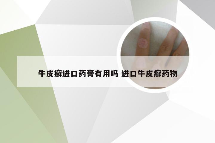 牛皮癣进口药膏有用吗 进口牛皮癣药物