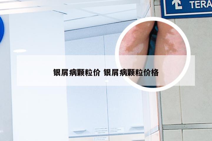 银屑病颗粒价 银屑病颗粒价格
