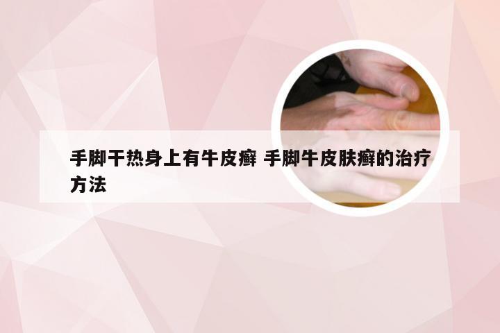 手脚干热身上有牛皮癣 手脚牛皮肤癣的治疗方法