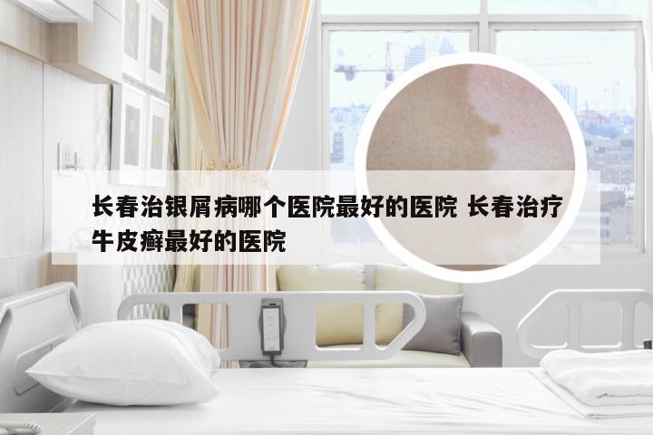 长春治银屑病哪个医院最好的医院 长春治疗牛皮癣最好的医院