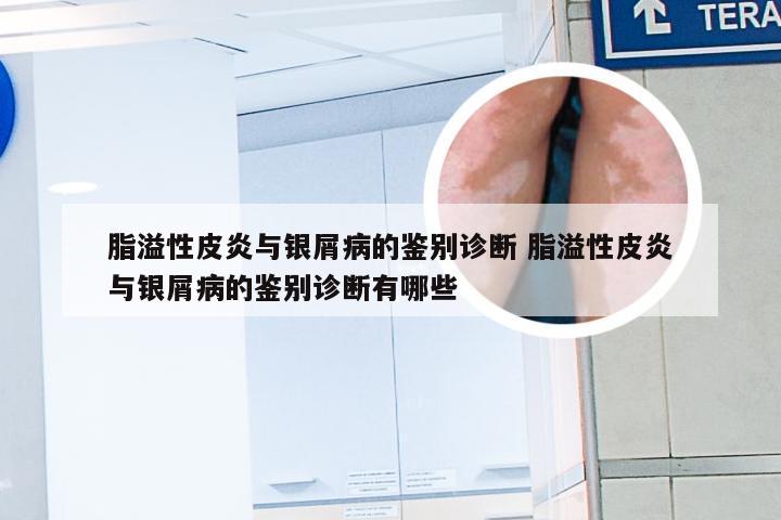 脂溢性皮炎与银屑病的鉴别诊断 脂溢性皮炎与银屑病的鉴别诊断有哪些