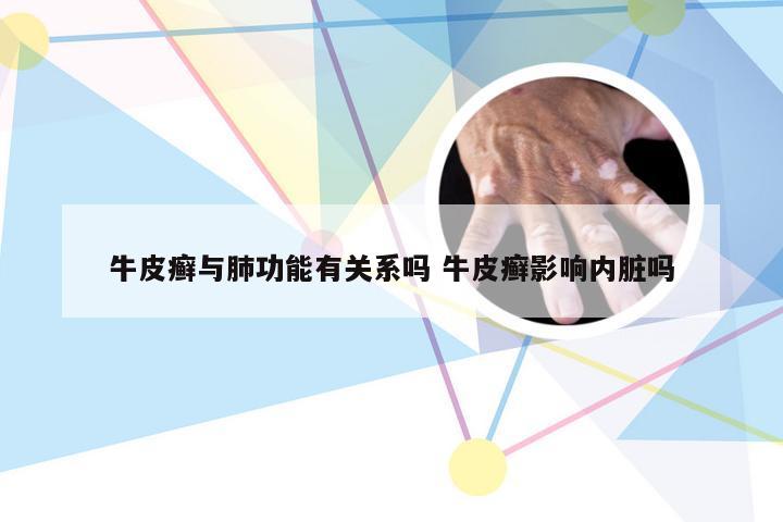 牛皮癣与肺功能有关系吗 牛皮癣影响内脏吗