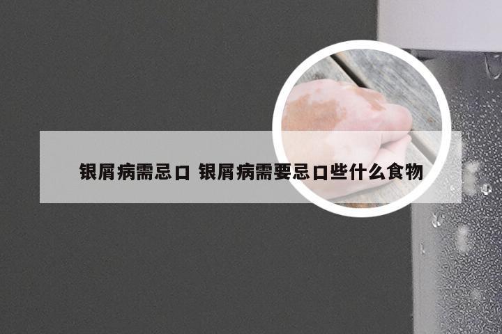 银屑病需忌口 银屑病需要忌口些什么食物