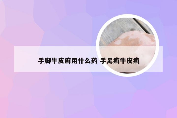 手脚牛皮癣用什么药 手足癣牛皮癣