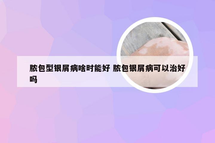 脓包型银屑病啥时能好 脓包银屑病可以治好吗