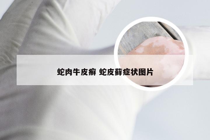 蛇肉牛皮癣 蛇皮藓症状图片