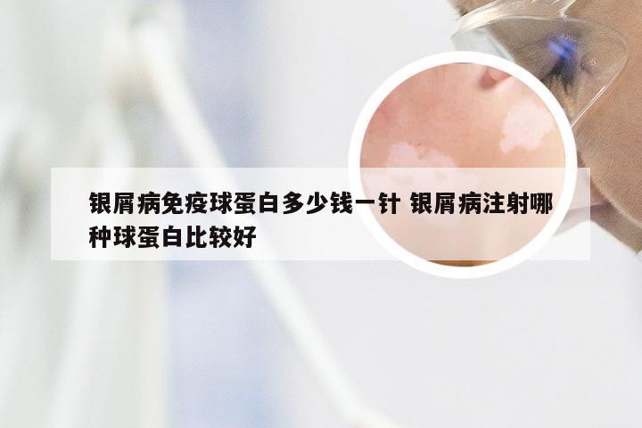 银屑病免疫球蛋白多少钱一针 银屑病注射哪种球蛋白比较好