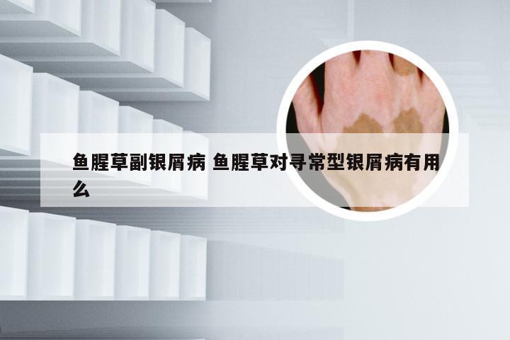 鱼腥草副银屑病 鱼腥草对寻常型银屑病有用么