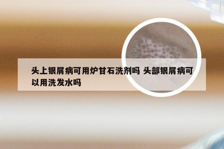 头上银屑病可用炉甘石洗剂吗 头部银屑病可以用洗发水吗