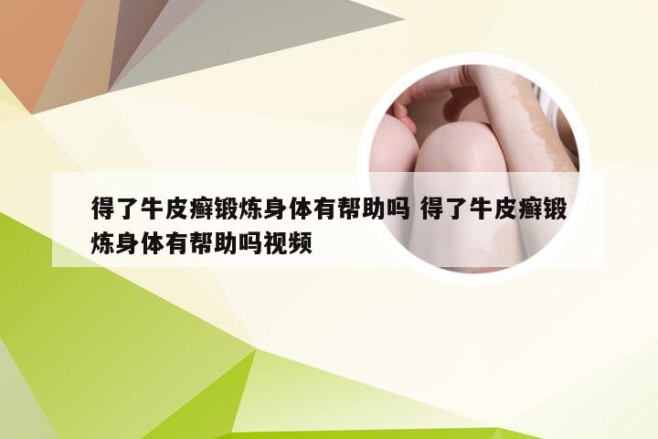 得了牛皮癣锻炼身体有帮助吗 得了牛皮癣锻炼身体有帮助吗视频