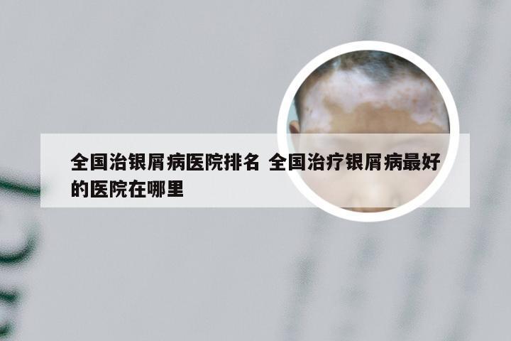 全国治银屑病医院排名 全国治疗银屑病最好的医院在哪里