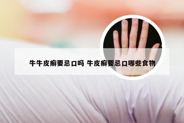 牛牛皮癣要忌口吗 牛皮癣要忌口哪些食物