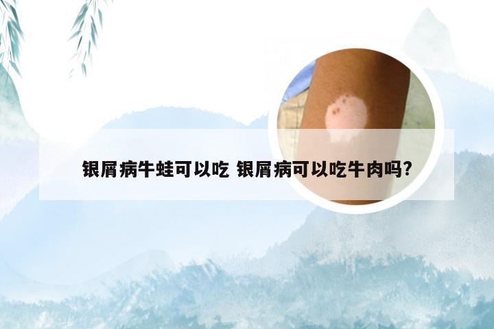 银屑病牛蛙可以吃 银屑病可以吃牛肉吗?