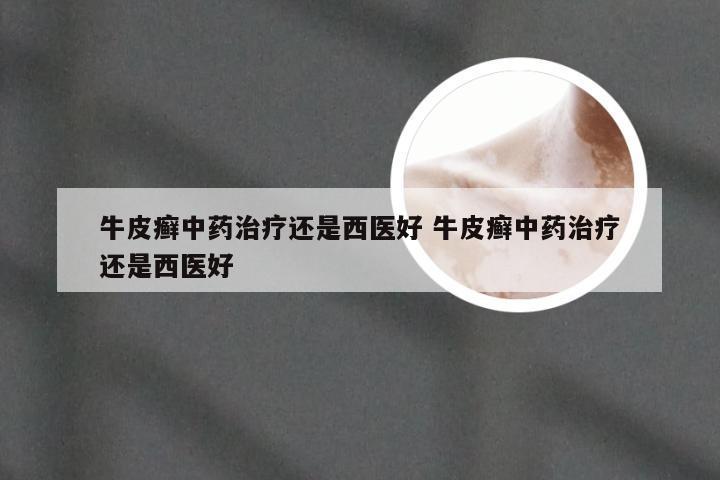 牛皮癣中药治疗还是西医好 牛皮癣中药治疗还是西医好