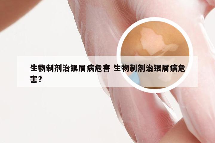 生物制剂治银屑病危害 生物制剂治银屑病危害?
