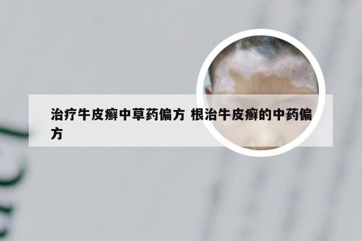治疗牛皮癣中草药偏方 根治牛皮癣的中药偏方