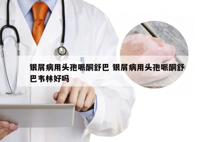 银屑病用头孢哌酮舒巴 银屑病用头孢哌酮舒巴韦林好吗