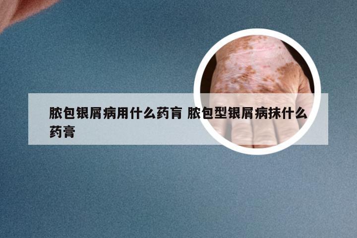 脓包银屑病用什么药肓 脓包型银屑病抹什么药膏