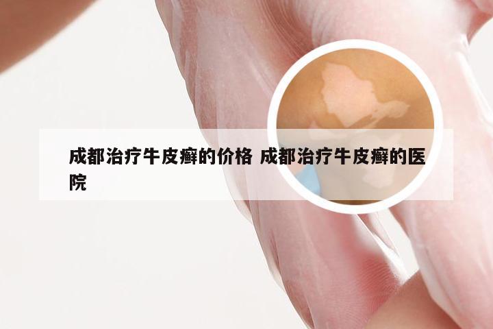 成都治疗牛皮癣的价格 成都治疗牛皮癣的医院
