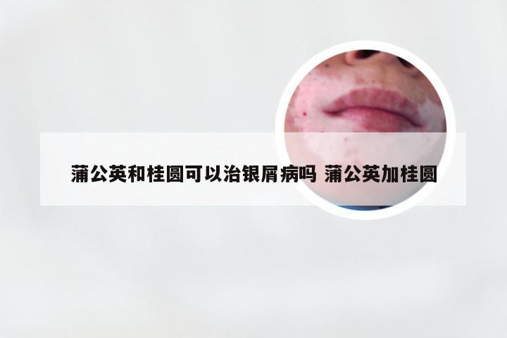 蒲公英和桂圆可以治银屑病吗 蒲公英加桂圆