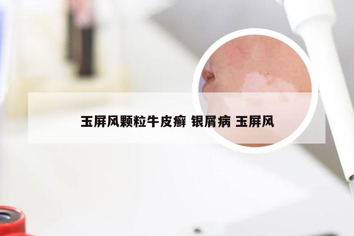 玉屏风颗粒牛皮癣 银屑病 玉屏风