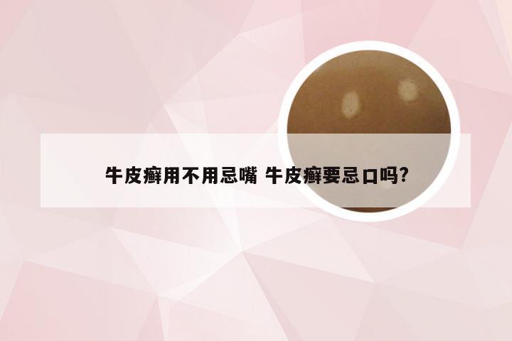 牛皮癣用不用忌嘴 牛皮癣要忌口吗?