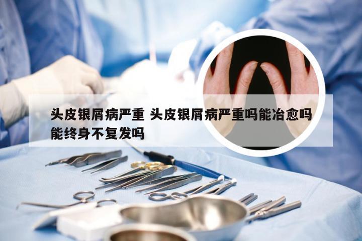 头皮银屑病严重 头皮银屑病严重吗能冶愈吗能终身不复发吗