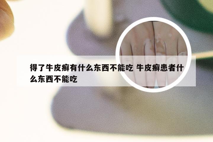 得了牛皮癣有什么东西不能吃 牛皮癣患者什么东西不能吃