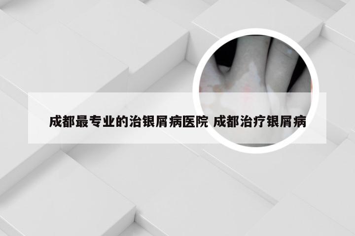 成都最专业的治银屑病医院 成都治疗银屑病