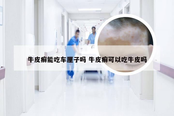 牛皮癣能吃车厘子吗 牛皮癣可以吃牛皮吗