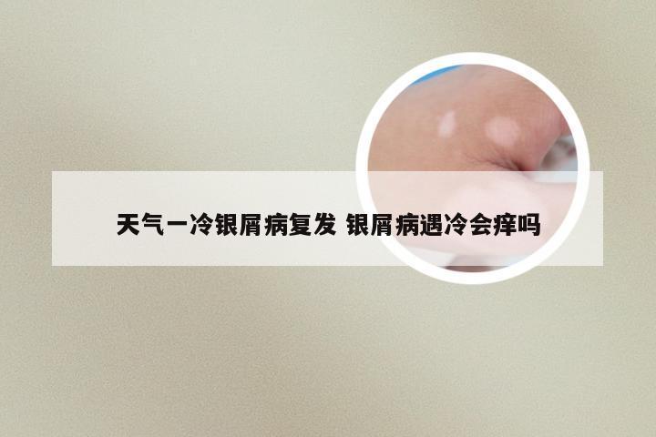 天气一冷银屑病复发 银屑病遇冷会痒吗