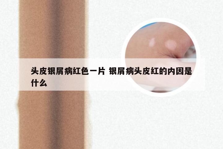 头皮银屑病红色一片 银屑病头皮红的内因是什么
