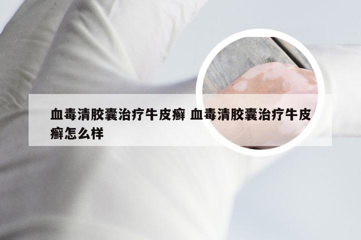 血毒清胶囊治疗牛皮癣 血毒清胶囊治疗牛皮癣怎么样