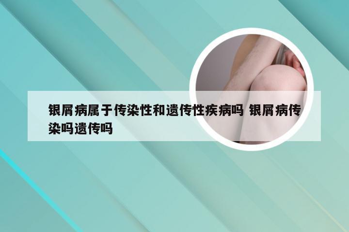 银屑病属于传染性和遗传性疾病吗 银屑病传染吗遗传吗