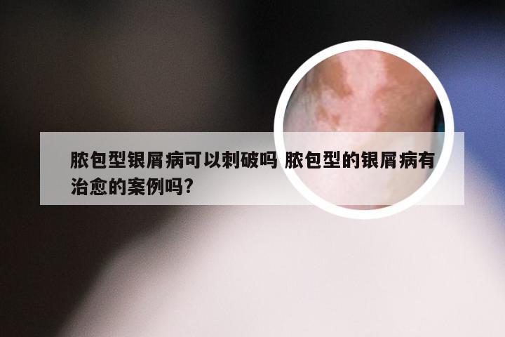 脓包型银屑病可以刺破吗 脓包型的银屑病有治愈的案例吗?