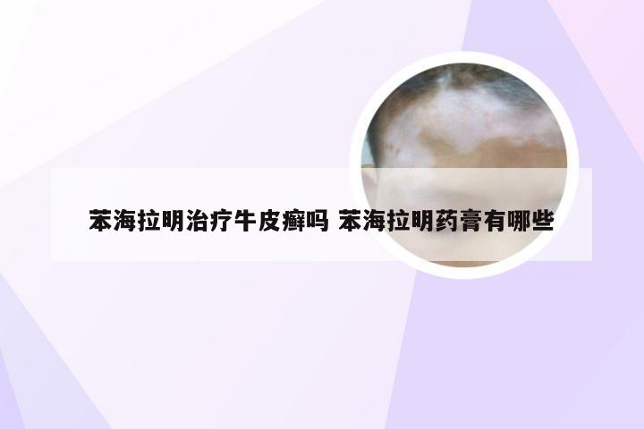 苯海拉明治疗牛皮癣吗 苯海拉明药膏有哪些
