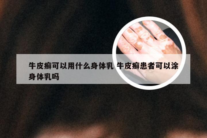 牛皮癣可以用什么身体乳 牛皮癣患者可以涂身体乳吗