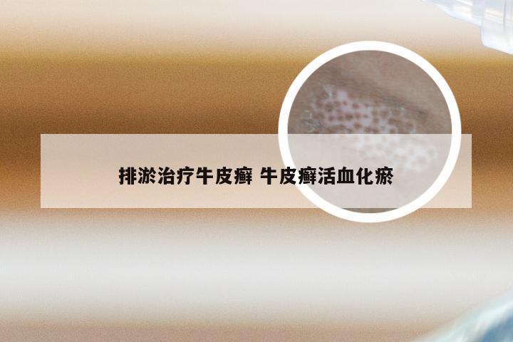排淤治疗牛皮癣 牛皮癣活血化瘀