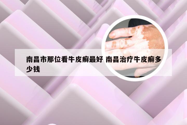 南昌市那位看牛皮癣最好 南昌治疗牛皮癣多少钱