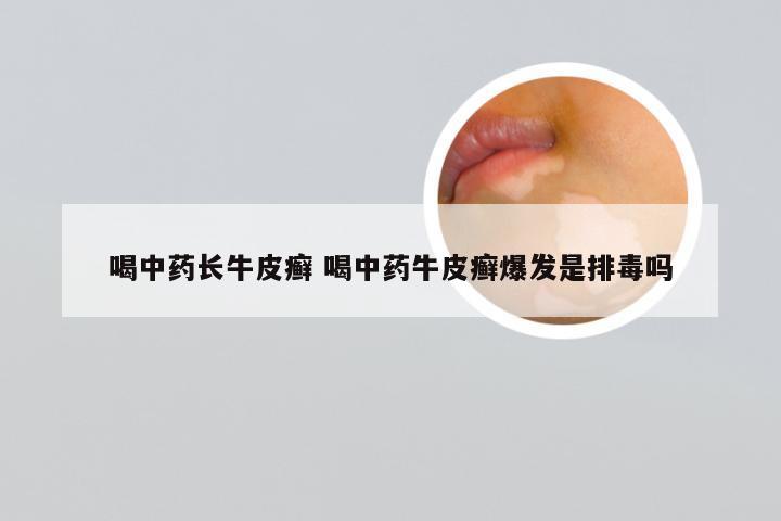 喝中药长牛皮癣 喝中药牛皮癣爆发是排毒吗