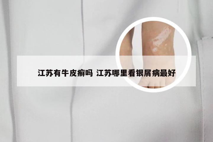 江苏有牛皮癣吗 江苏哪里看银屑病最好