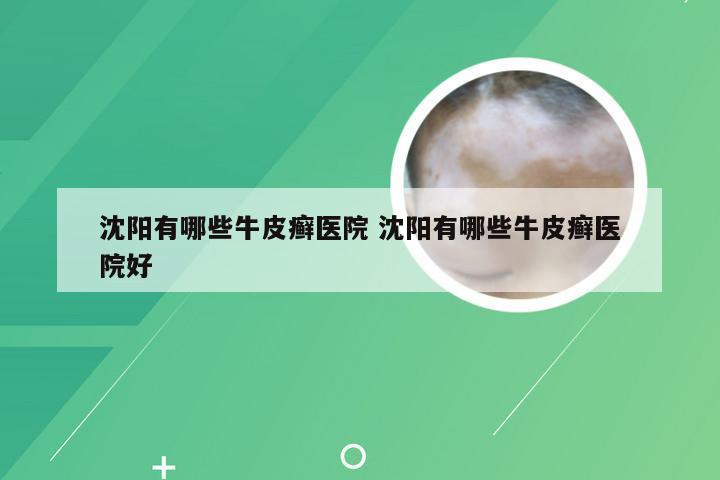 沈阳有哪些牛皮癣医院 沈阳有哪些牛皮癣医院好