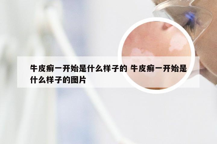牛皮癣一开始是什么样子的 牛皮癣一开始是什么样子的图片