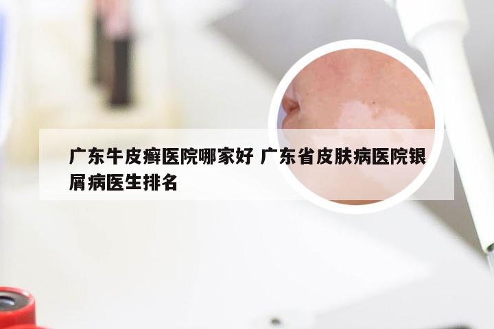 广东牛皮癣医院哪家好 广东省皮肤病医院银屑病医生排名